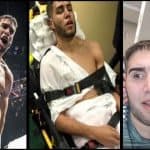 Colon in different stages