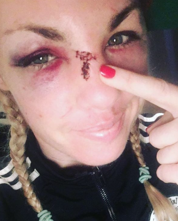 heather hardy showing her injured face