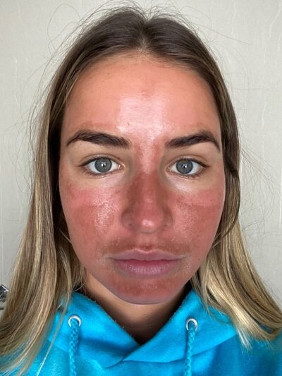 Madi Edwards Melasma