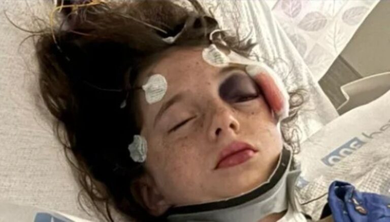 Sophia Martinez eye socket