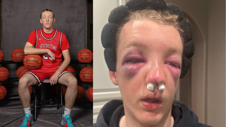 Dylan Alvidrez facial injuries